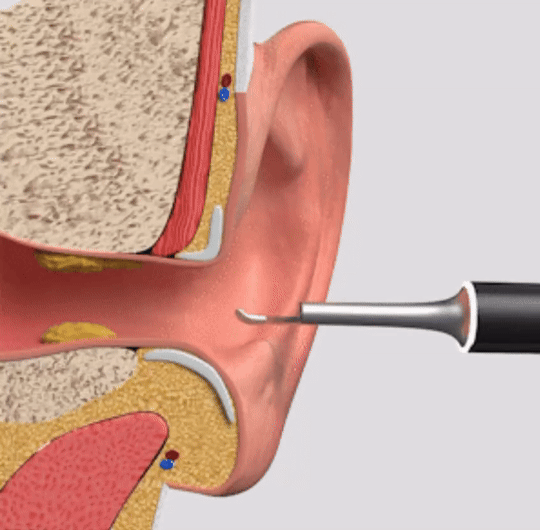 EarView